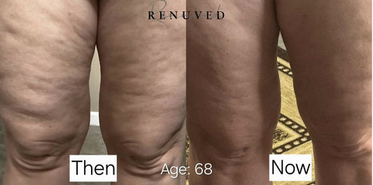The Truth About Cellulite After 50 (And How Renuved Infuse & Improve Cream Can Help You Finally See Results)