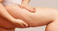 Is It Actually Possible to Get Rid of Cellulite?