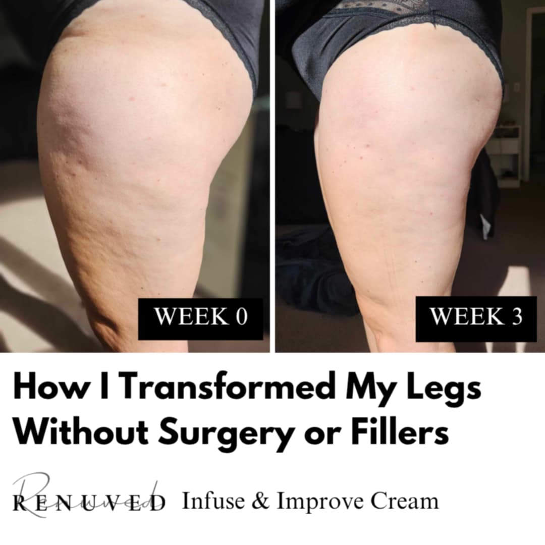 How to Reduce Cellulite Naturally: Say Hello to Smoother Skin with Renuved Infuse & Improve Cream