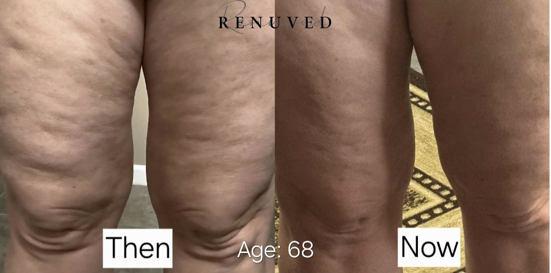 The Truth About Cellulite After 50 (And How Renuved Infuse & Improve Cream Can Help You Finally See Results)