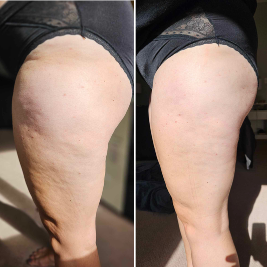 Prepare Your Legs for Warmer Weather with RenuvedInfuse & Improve Cream